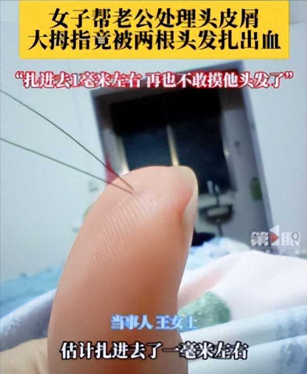 女子手指被丈夫2根头发扎出血